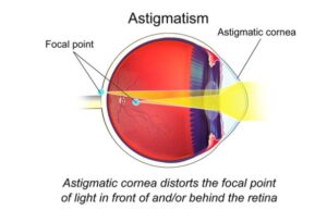 Astigmatism